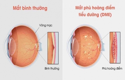 PHÙ HOÀNG ĐIỂM DO TIỂU ĐƯỜNG – NGUYÊN NHÂN, TRIỆU CHỨNG VÀ ĐIỀU TRỊ